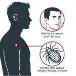 bed bugs hiding on body