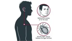 bed bugs hiding on body